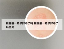 银屑病一辈子好不了吗 银屑病一辈子好不了吗图片