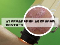 冶了银屑病最新生物制剂 治疗银屑病的生物制剂多少钱一支