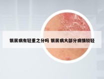 银屑病有轻重之分吗 银屑病大部分病情较轻