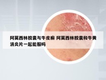 阿莫西林胶囊与牛皮癣 阿莫西林胶囊和牛黄消炎片一起能服吗