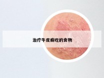 治疗牛皮癣吃的食物