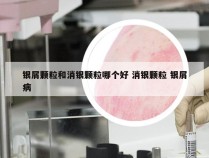 银屑颗粒和消银颗粒哪个好 消银颗粒 银屑病