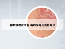 廨症状图片大全 癣的图片及治疗方法