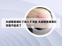 头部银屑病红了很久不消退 头部银屑病发红但是不起皮了