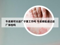牛皮癣可以进厂子里工作吗 牛皮癣能通过进厂体检吗