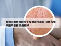 郑州市那所医院对牛皮癣治疗最好 郑州市哪家医院看糖尿病最好