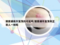 银屑病有不复发的可能吗 银屑病不复发和正常人一样吗