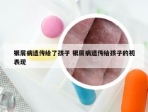 银屑病遗传给了孩子 银屑病遗传给孩子的初表现