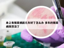 身上有银屑病前几年好了怎么办 多年的银屑病突然没了