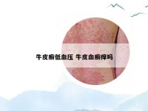 牛皮癣低血压 牛皮血癣痒吗