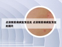 点滴银屑病病复发征兆 点滴银屑病病复发征兆图片