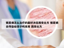 银屑病怎么治疗的最好决定西安北方 银屑病会传染给孩子吗采用 西安北方