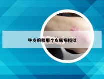 牛皮癣和那个皮肤病相似