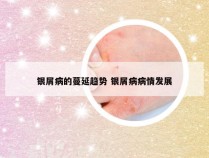 银屑病的蔓延趋势 银屑病病情发展