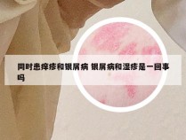 同时患痒疹和银屑病 银屑病和湿疹是一回事吗