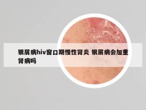 银屑病hiv窗口期慢性肾炎 银屑病会加重肾病吗
