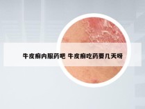 牛皮癣内服药吧 牛皮癣吃药要几天呀
