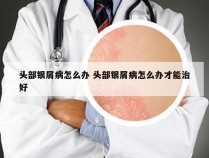 头部银屑病怎么办 头部银屑病怎么办才能治好