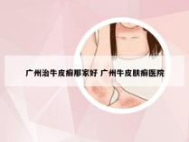 广州治牛皮癣那家好 广州牛皮肤癣医院