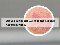 银屑病全世界都不能治愈吗 银屑病全世界都不能治愈吗为什么