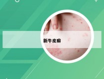 新牛皮癣
