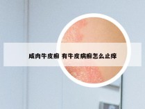 咸肉牛皮癣 有牛皮病癣怎么止痒