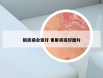 银屑病会变好 银屑病变好图片