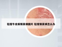 轻度牛皮癣银屑病图片 轻度银屑病怎么办