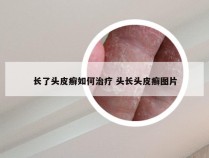 长了头皮癣如何治疗 头长头皮癣图片