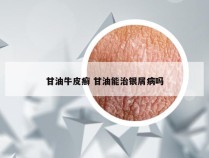 甘油牛皮癣 甘油能治银屑病吗