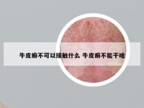 牛皮癣不可以接触什么 牛皮癣不能干啥