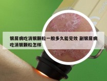 银屑病吃消银颗粒一般多久能见效 副银屑病吃消银颗粒怎样