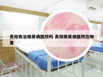 贵阳有治银屑病医院吗 贵阳银屑病医院在哪里