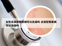 女性点滴状银屑病可以洗澡吗 点滴型银屑病可以泡澡吗