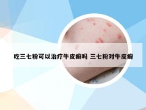 吃三七粉可以治疗牛皮癣吗 三七粉对牛皮癣