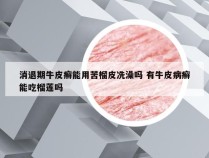 消退期牛皮癣能用苦榴皮冼澡吗 有牛皮病癣能吃榴莲吗