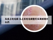 头皮上吃毛癣 头上长吃毛癣整片头发掉用什么药