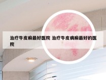 治疗牛皮癣最好医院 治疗牛皮病癣最好的医院