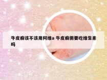 牛皮癣该不该用阿维a 牛皮癣需要吃维生素吗