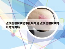 点滴型银屑病能不能喝鸡汤 点滴型银屑病可以吃鸡肉吗