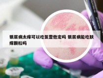 银屑病太痒可以吃氯雷他定吗 银屑病能吃肤痒颗粒吗