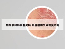 银屑病和环境有关吗 银屑病跟气候有关系吗