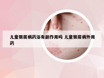 儿童银屑病药浴有副作用吗 儿童银屑病外用药