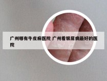 广州哪有牛皮癣医院 广州看银屑病最好的医院
