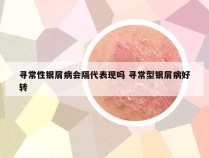 寻常性银屑病会隔代表现吗 寻常型银屑病好转