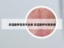 高锰酸钾清洗牛皮癣 高锰酸钾对银屑病