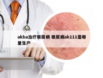 akba治疗银屑病 银屑病ak111是哪里生产