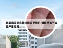 银屑病关节炎是啥原因导致的 银屑病关节炎最严重后果