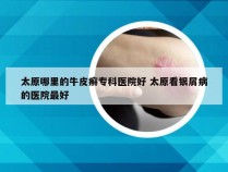 太原哪里的牛皮癣专科医院好 太原看银屑病的医院最好