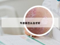 牛皮癣怎么治才好